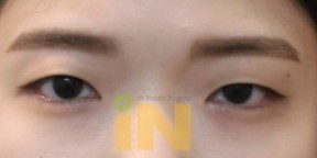 쌍꺼풀 수술은 싫고 눈두덩이가 통통한 사람들이 선호한다는 수술 jpg | 인스티즈