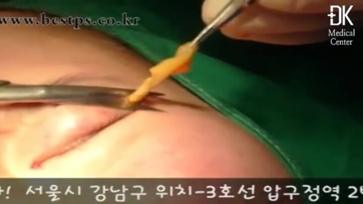 쌍꺼풀 수술은 싫고 눈두덩이가 통통한 사람들이 선호한다는 수술 jpg | 인스티즈