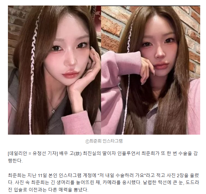 "또 수술하러 간다" 최준희, 몰라보게 달라진 얼굴…과거 앓았던 '루푸스' 어떤 병? | 인스티즈