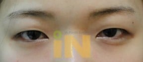 쌍꺼풀 수술은 싫고 눈두덩이가 통통한 사람들이 선호한다는 수술 jpg | 인스티즈