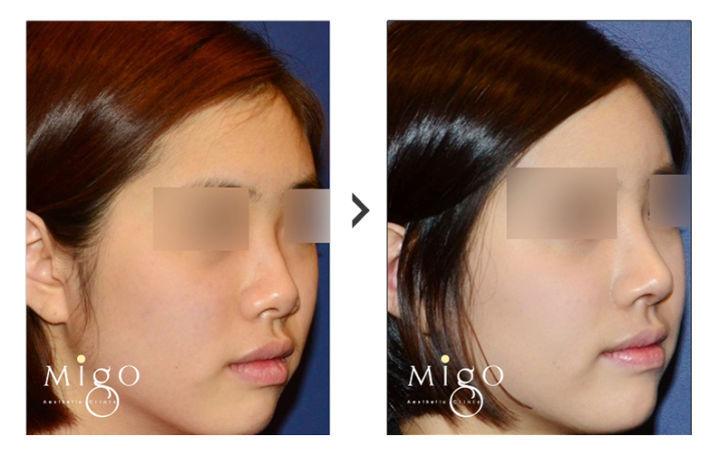 성형외과 종사자들이 말하는 부작용 위험높은 수술 쓰리톱 (혐오주의) | 인스티즈