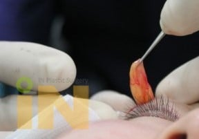 쌍꺼풀 수술은 싫고 눈두덩이가 통통한 사람들이 선호한다는 수술 jpg | 인스티즈