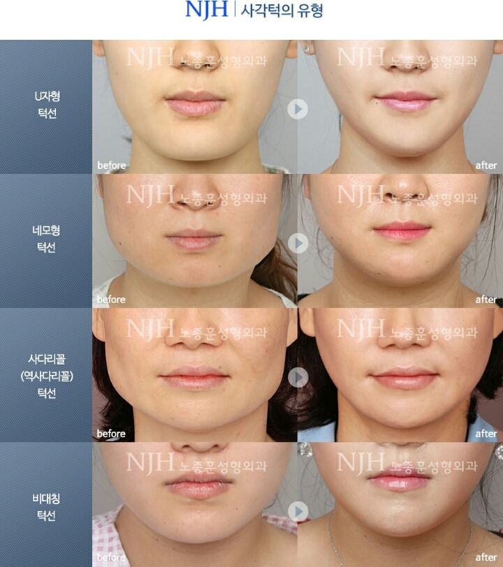 성형외과 종사자들이 말하는 부작용 위험높은 수술 쓰리톱 (혐오주의) | 인스티즈