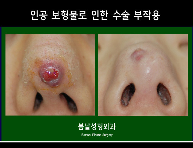 성형외과 종사자들이 말하는 부작용 위험높은 수술 쓰리톱 (혐오주의) | 인스티즈