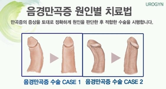 일부 남자들이 가지고 있는 음경만곡증 (페로니병) | 인스티즈