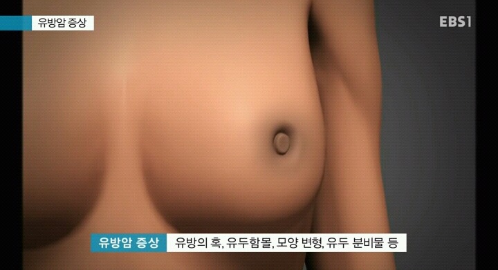 유방암환자들이 말하는 유방암 증상.jpg | 인스티즈