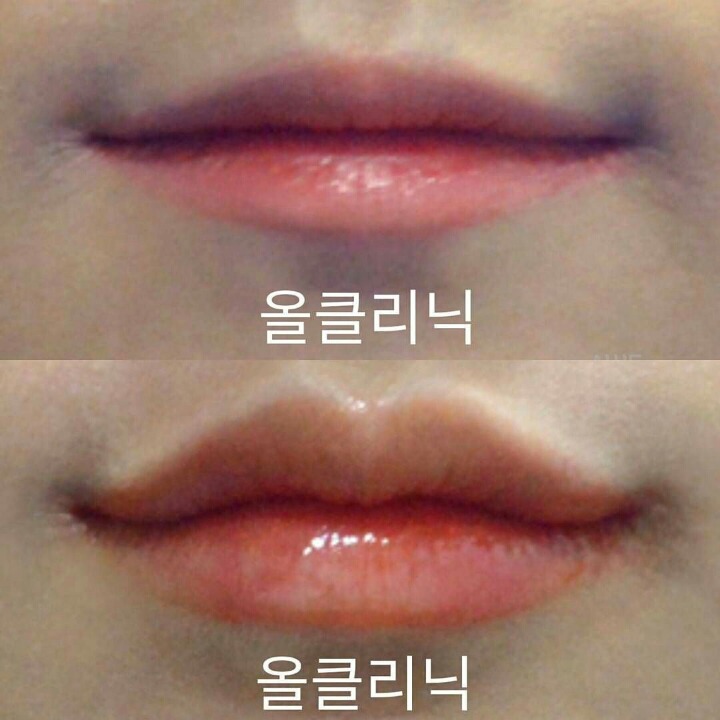 요즘 유행한다는 성형수술.jpg | 인스티즈