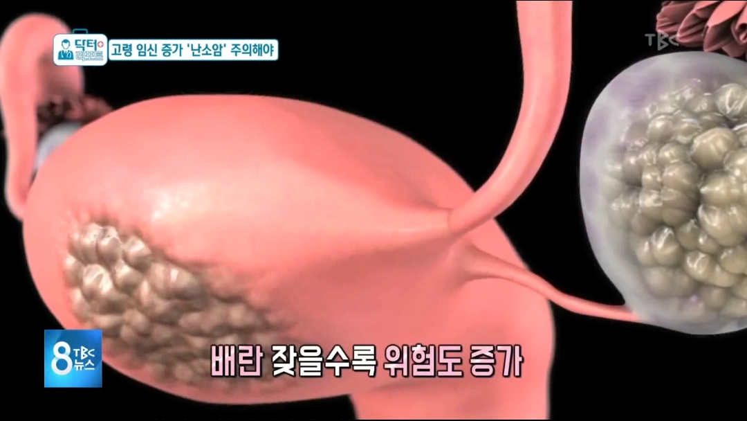 난소암이 무서운 이유.jpg | 인스티즈
