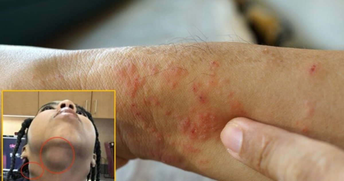 "10대 때부터 피부 습진인 줄”…알고 보니 4기 암, 29세女에 무슨 일? | 인스티즈