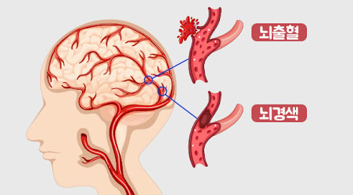 뇌졸중에 대해 알아보자 (장문 주의, 그래도 읽어 줘) | 인스티즈