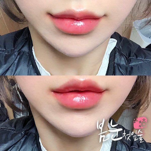 요즘 유행한다는 성형수술.jpg | 인스티즈
