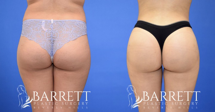 외국에서 유행하는 뒤태 성형수술,, | 인스티즈