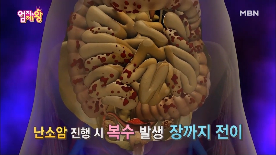 난소암이 무서운 이유.jpg | 인스티즈