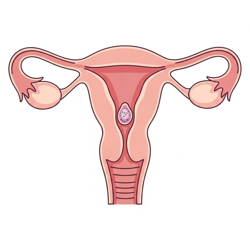 [위클리 건강] '2030 자궁내막암' 왜 많나 했더니…"뇌관은 따로 있었다" | 인스티즈