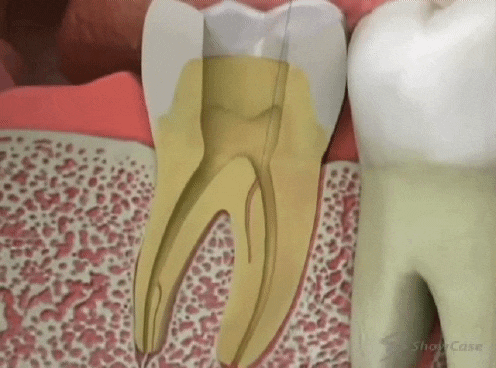 신경치료와 재신경치료...... | 인스티즈