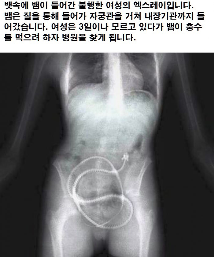 여자 몸 안에 몰래 들어간 뱀 엑스레이.jpg | 인스티즈