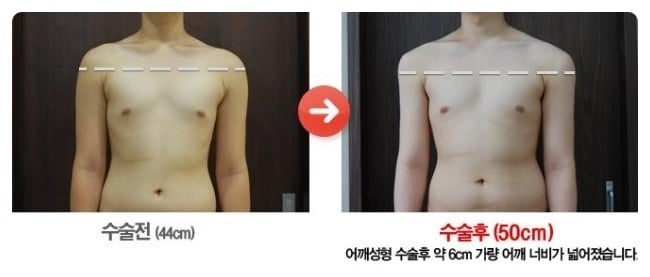 남자 어깨성형.jpg | 인스티즈