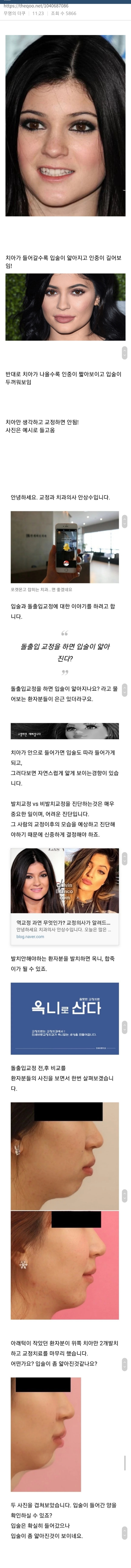 사람들이 잘 모르는 치아교정 할때 생기는 입술 변화.jpg | 인스티즈