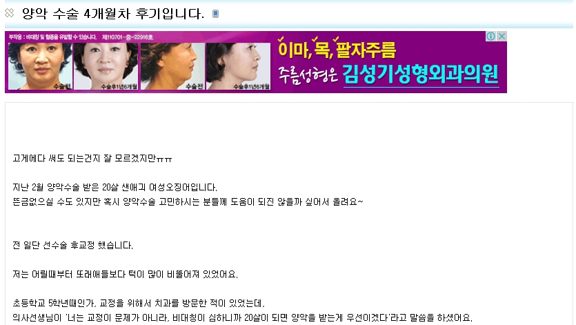 양악 수술 4개월차 후기 | 인스티즈