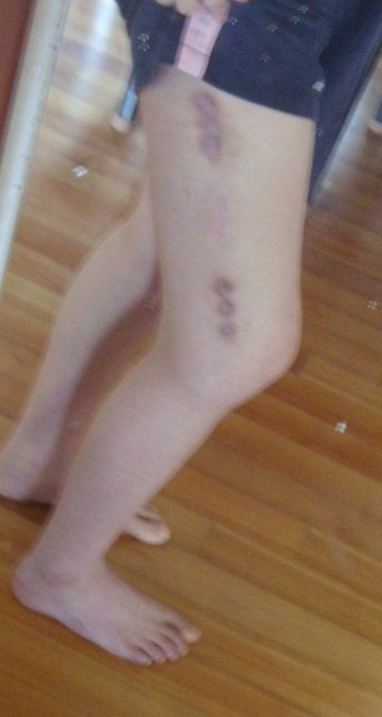  위험하다고 알려진 키크는 수술 | 인스티즈