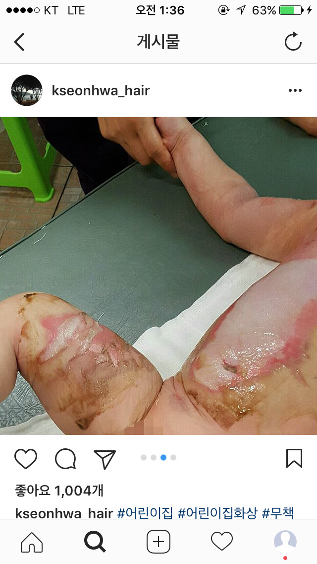 화상 입은 애기 나몰라라 하는 어린이집 | 인스티즈