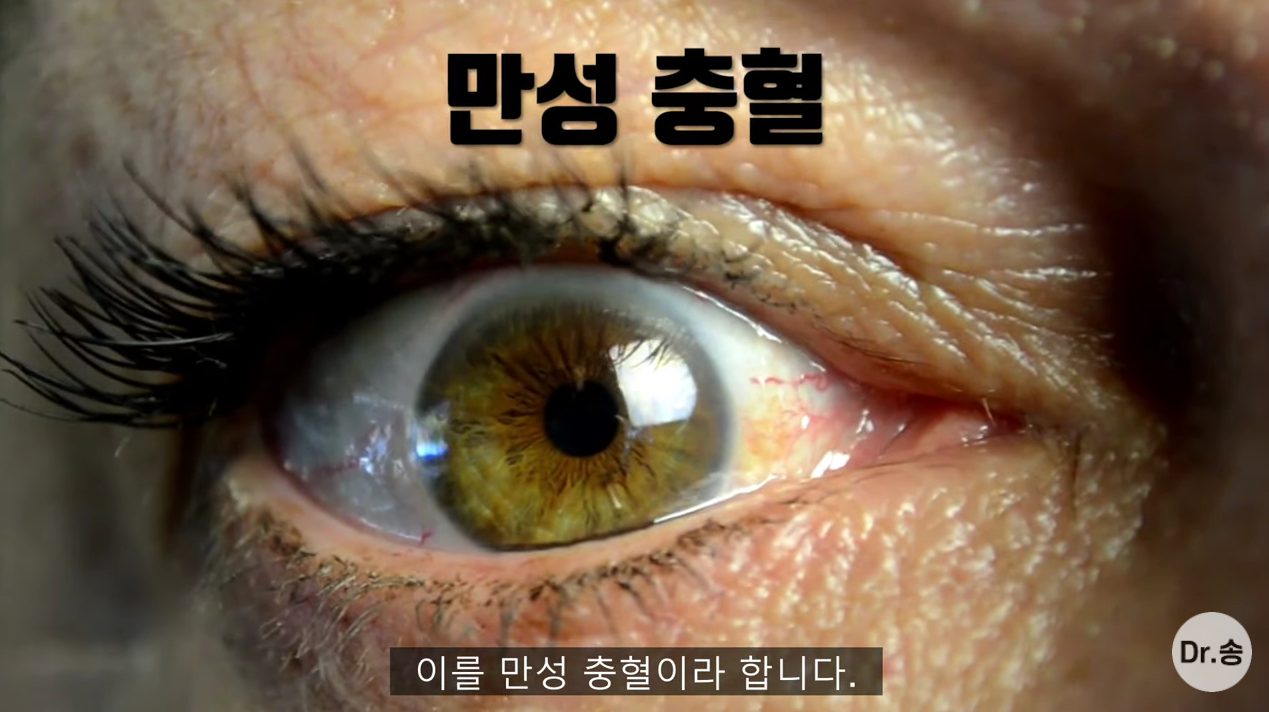 눈 충혈 없애는 법 - 만성 충혈은 이렇게 관리하는 겁니다 | 인스티즈