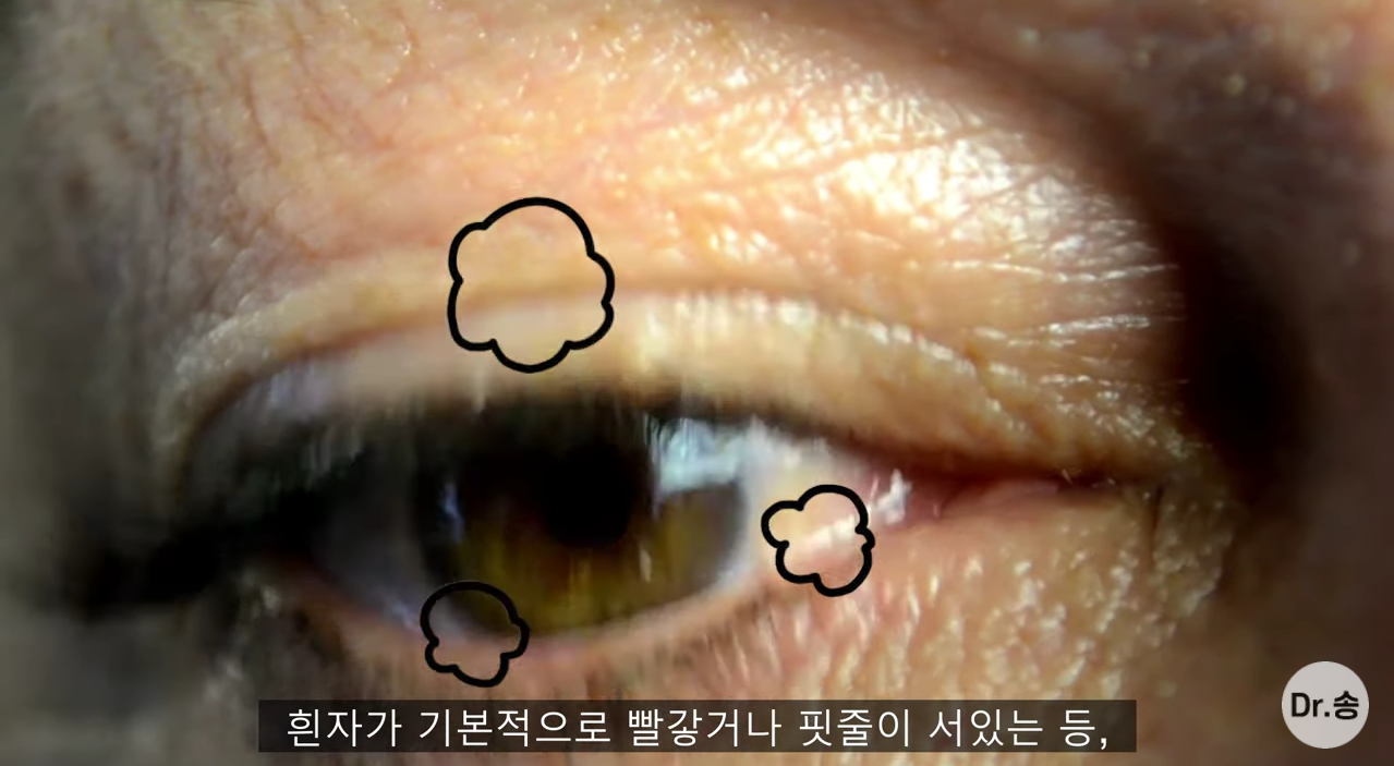 눈 충혈 없애는 법 - 만성 충혈은 이렇게 관리하는 겁니다 | 인스티즈