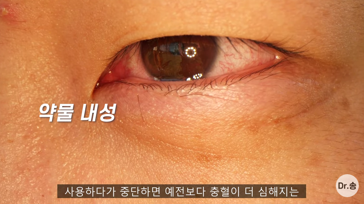 눈 충혈 없애는 법 - 만성 충혈은 이렇게 관리하는 겁니다 | 인스티즈