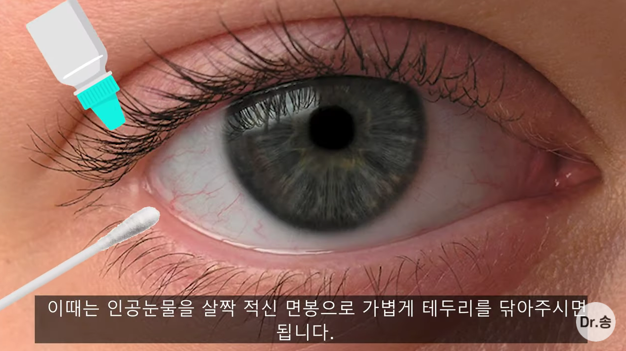 눈 충혈 없애는 법 - 만성 충혈은 이렇게 관리하는 겁니다 | 인스티즈