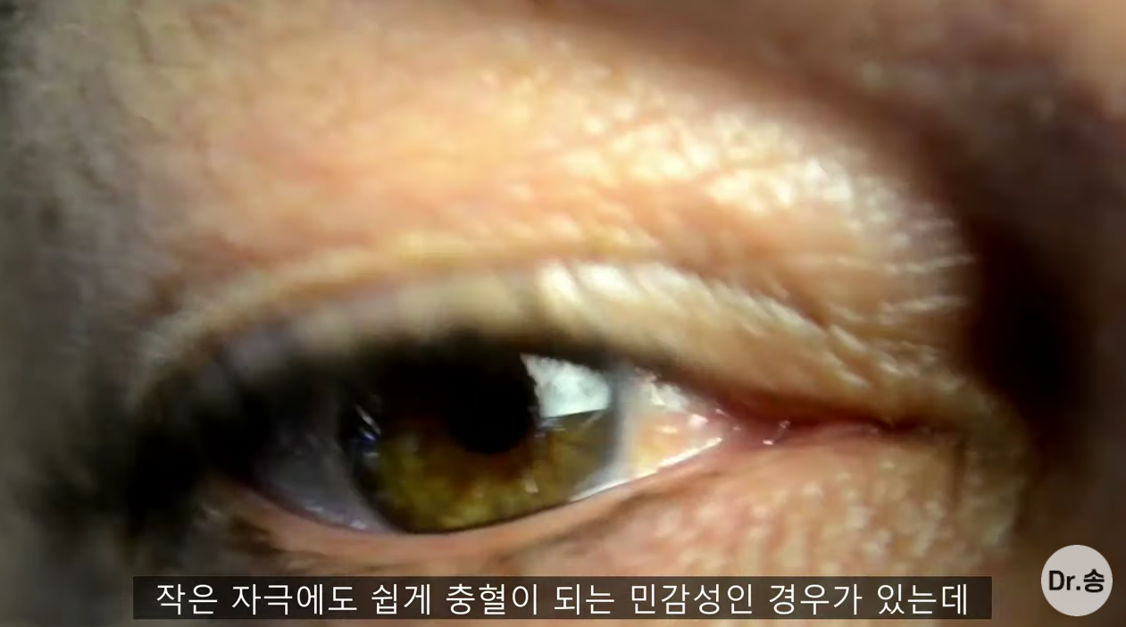 눈 충혈 없애는 법 - 만성 충혈은 이렇게 관리하는 겁니다 | 인스티즈