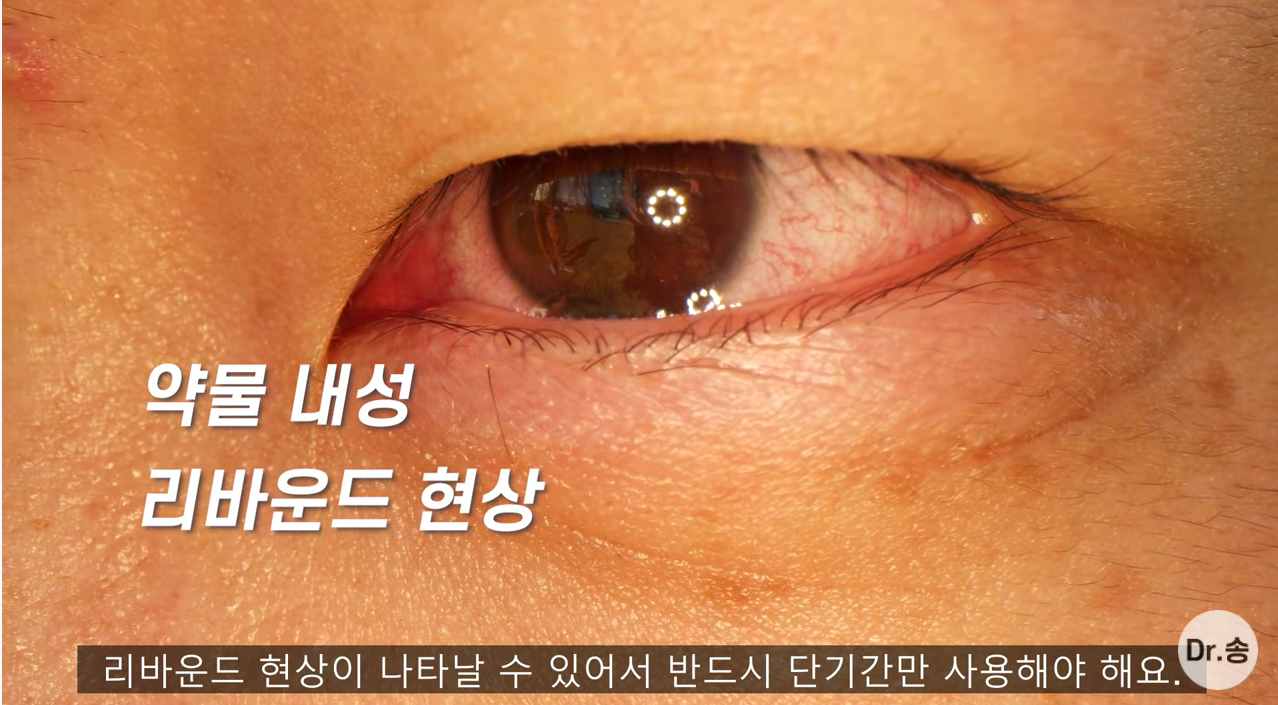 눈 충혈 없애는 법 - 만성 충혈은 이렇게 관리하는 겁니다 | 인스티즈
