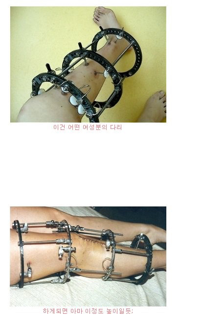  위험하다고 알려진 키크는 수술 | 인스티즈