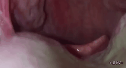 의외로 많은 사람들이 가지고 있는데 모르는 편도결석 | 인스티즈