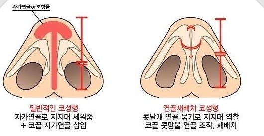 코성형중에서 필러 다음으로 인기가 많은 수술.jpg | 인스티즈
