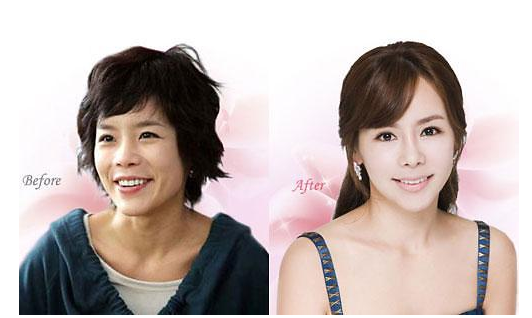 몇년전 엄청 유행하던 성형수술 | 인스티즈