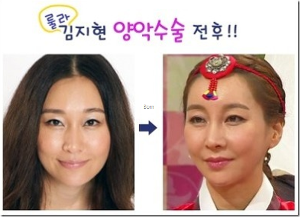 몇년전 엄청 유행하던 성형수술 | 인스티즈