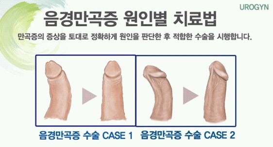 일부 남자들이 가지고 있는 음경만곡증 (페로니병) | 인스티즈