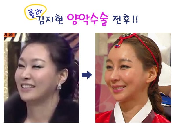 몇년전 엄청 유행하던 성형수술 | 인스티즈