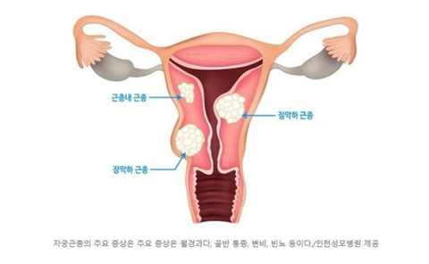요즘 2030여성들에게 급증하고 있다는 종양.jpg | 인스티즈