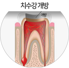 충치치료할때 뜯어내는 신경조직들.jpg | 인스티즈
