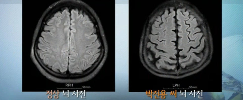 술을 안 마시면 헛것이 보이는 49살 남성의 몸 상태 | 인스티즈