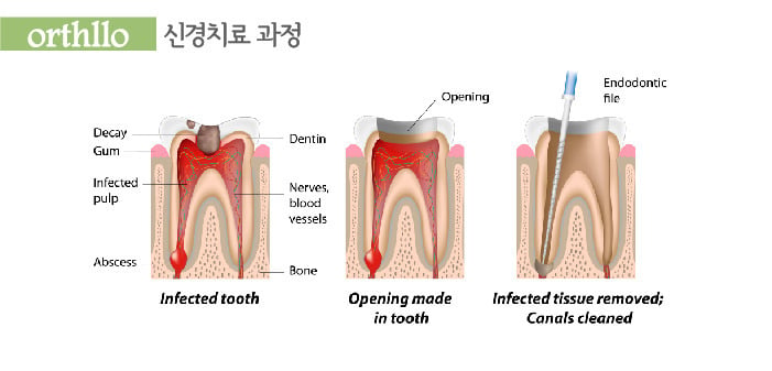 충치치료할때 뜯어내는 신경조직들.jpg | 인스티즈