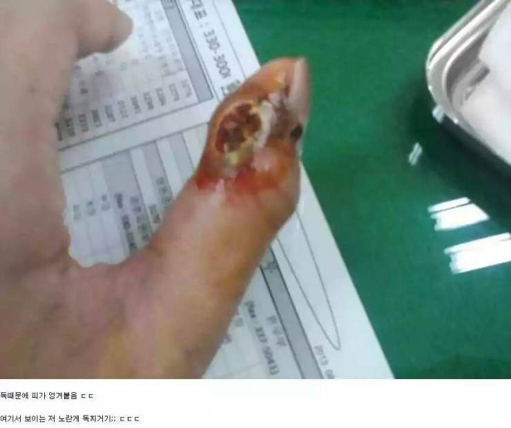 쇠살모사 물린 손가락 치유과정.jpg (혐오주의) | 인스티즈