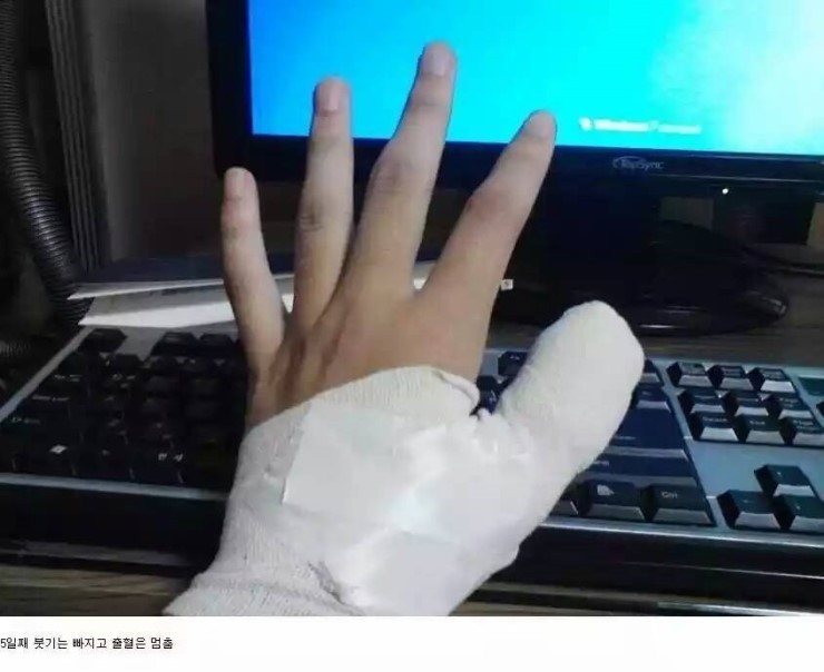 쇠살모사 물린 손가락 치유과정.jpg (혐오주의) | 인스티즈