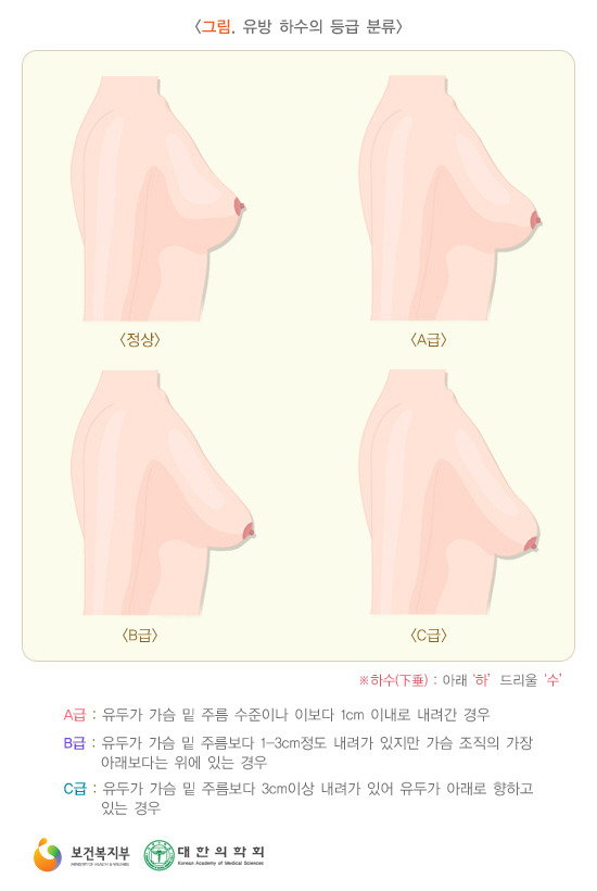 유방 하수(쳐진 가슴) 수술법.jpg | 인스티즈