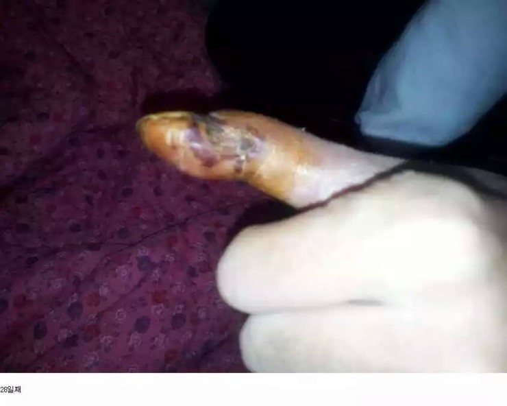 쇠살모사 물린 손가락 치유과정.jpg (혐오주의) | 인스티즈