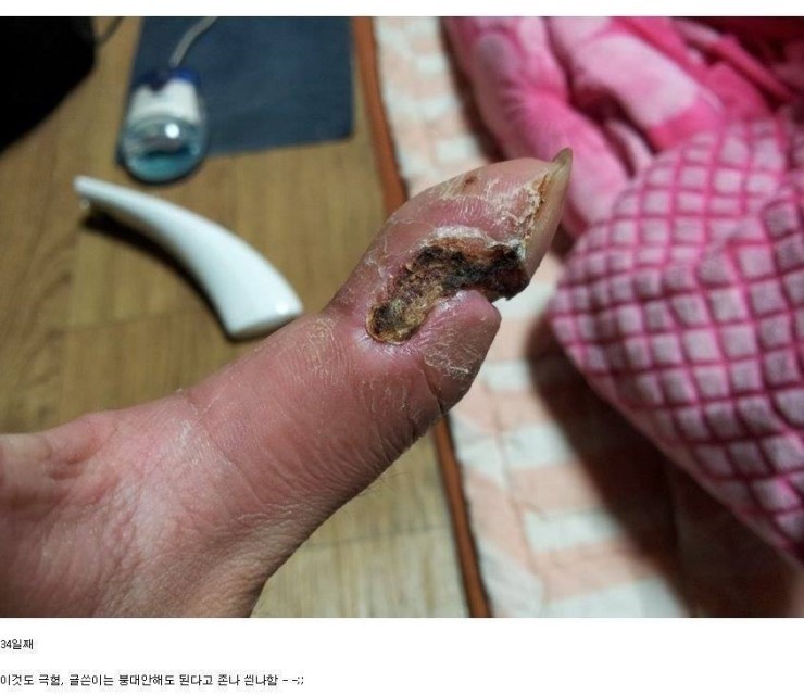쇠살모사 물린 손가락 치유과정.jpg (혐오주의) | 인스티즈
