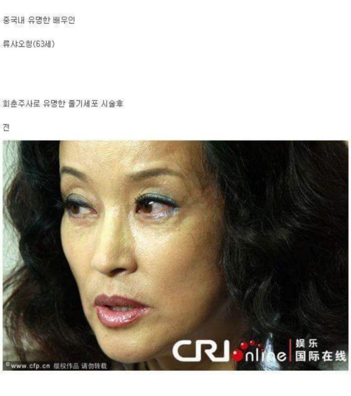 중국 여배우의 줄기세포 시술 전.후 | 인스티즈