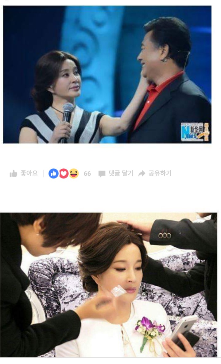 중국 여배우의 줄기세포 시술 전.후 | 인스티즈