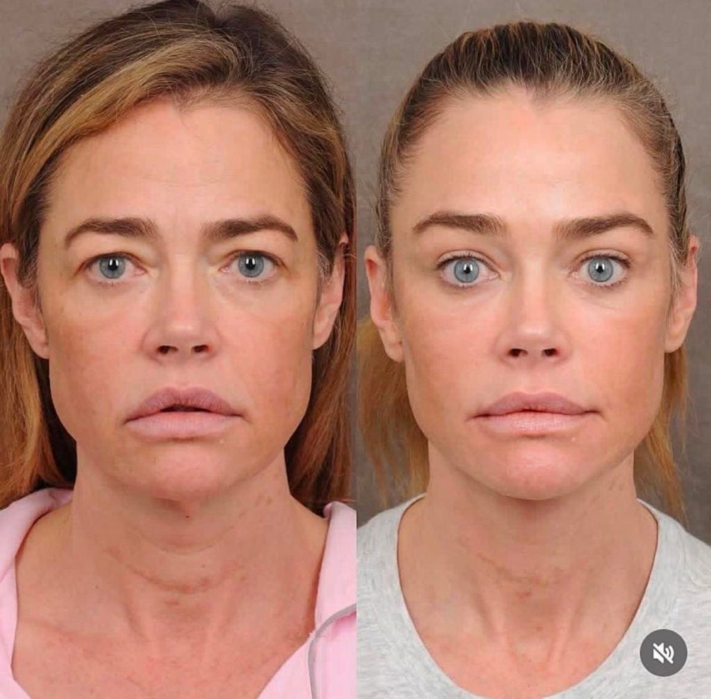 안면리프팅 한 배우 데니스 리차드 | 인스티즈